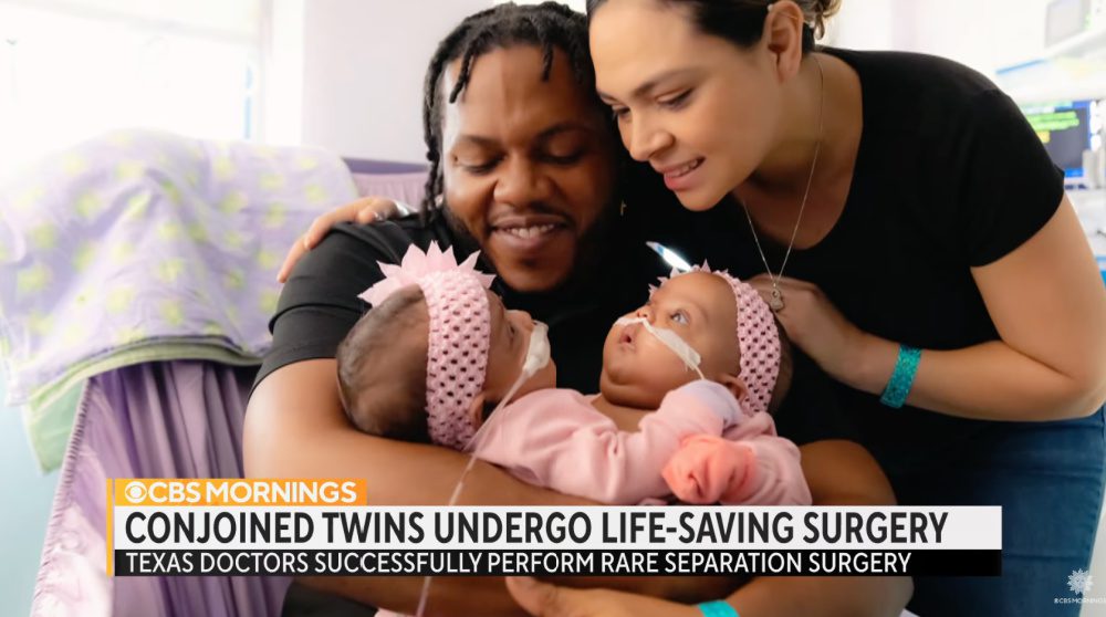 Conjoined Twins AmieLynn and JamieLynn Successfully Separated By Texas Doctors After 11-Hour Surgery