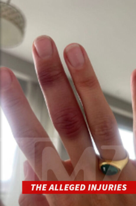 Grace-Jabbari-injured-finger