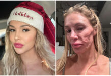 Brandi Glanville Blames Bravo For Disfigured Face & Health Woes Brandi-Glanville-disfigured-face-blames-Bravo-2