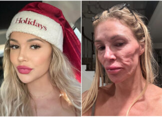 Brandi Glanville Blames Bravo For Disfigured Face & Health Woes Brandi-Glanville-disfigured-face-blames-Bravo-2
